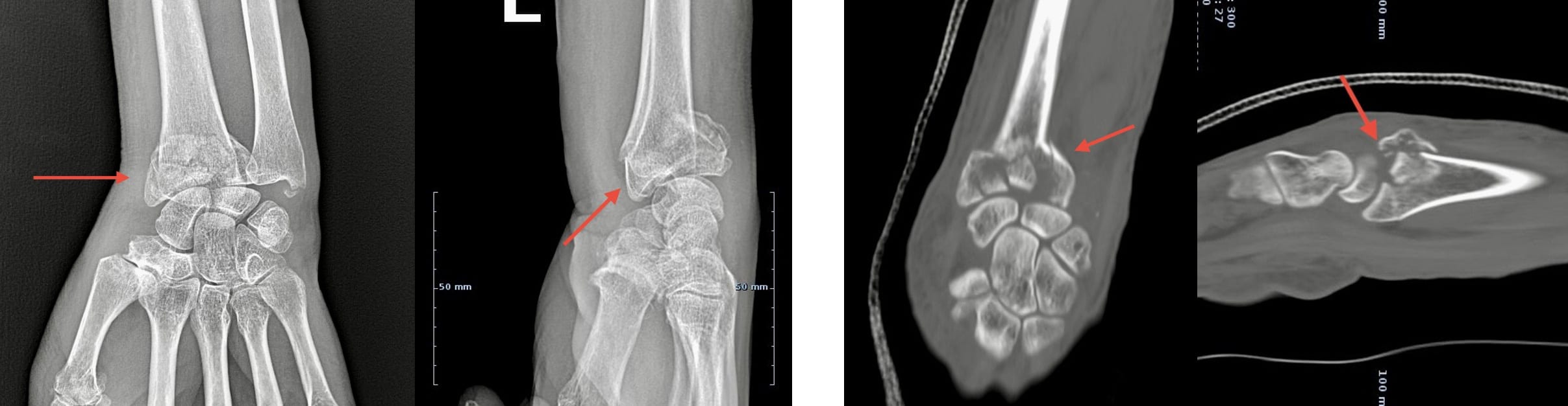 Raio-X e TAC de uma fractura multifragmentar complexa do rádio distal, com afundamento da superfície articular