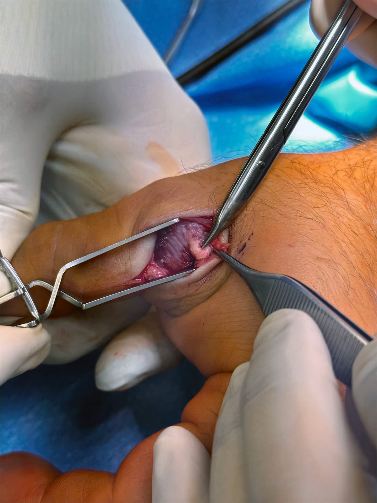 Aspecto per-operatório de uma lesão de Stener, com o ligamento desviado da sua posição anatómica