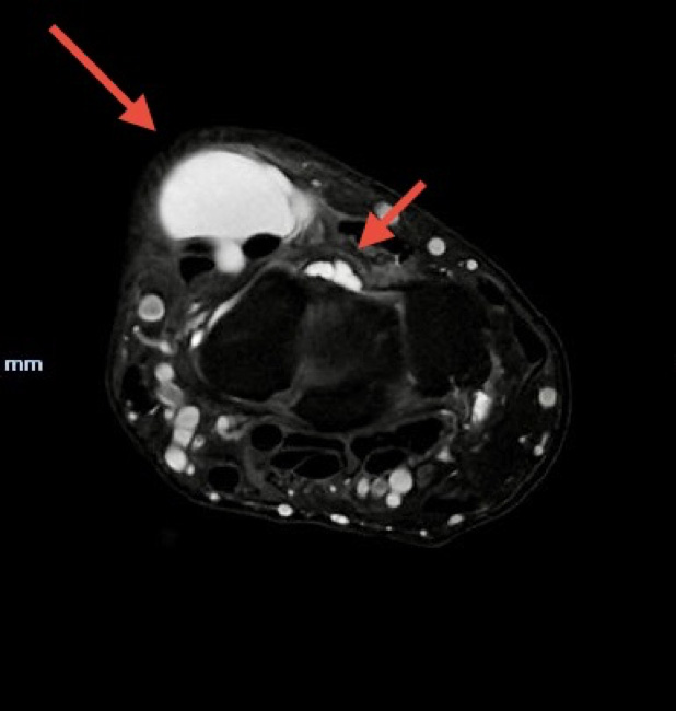 Imagem de ressonância magnética demonstrando volumoso quisto sinovial dorsal, insinuando-se junto ao ligamento escafo-lunar