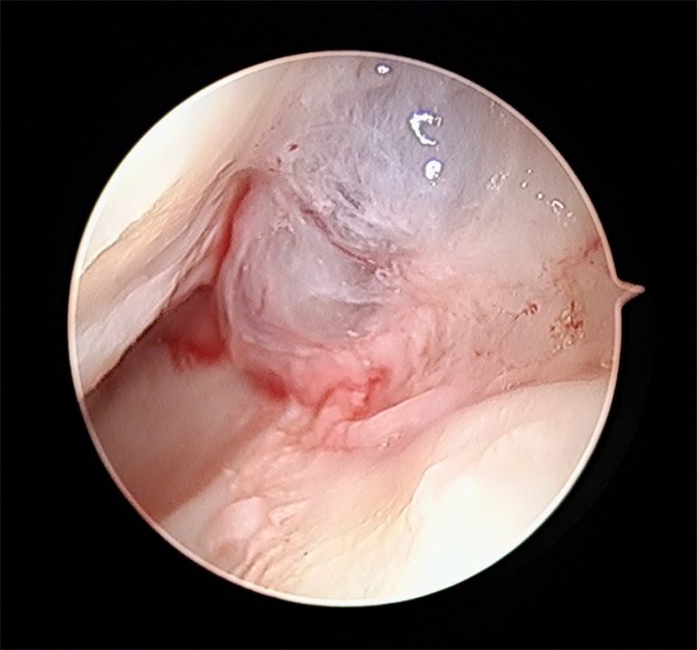 Aspecto intra-articular de um volumoso quisto sinovial, visto por artroscopia